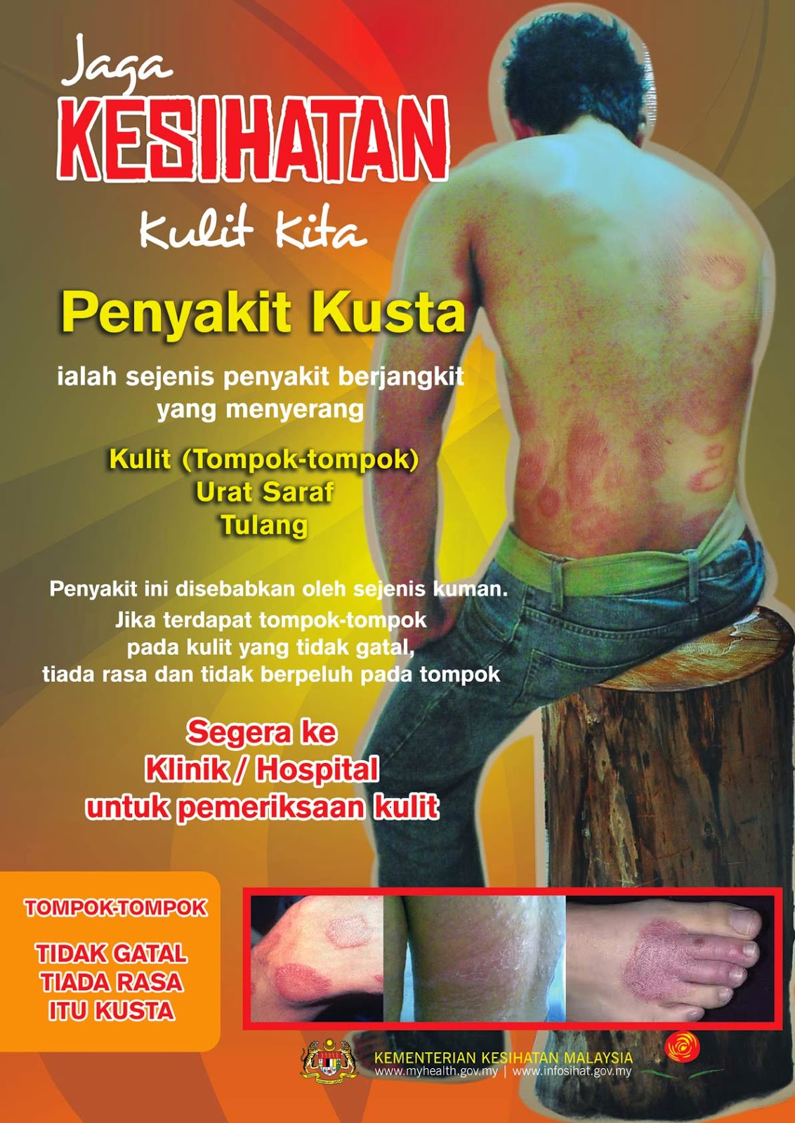 UNIT TIBI / KUSTA JKNPAHANG: PENYAKIT KUSTA
